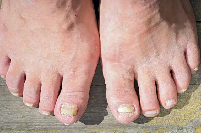 remedios caseros para combatir la micosis en las uñas de los pies