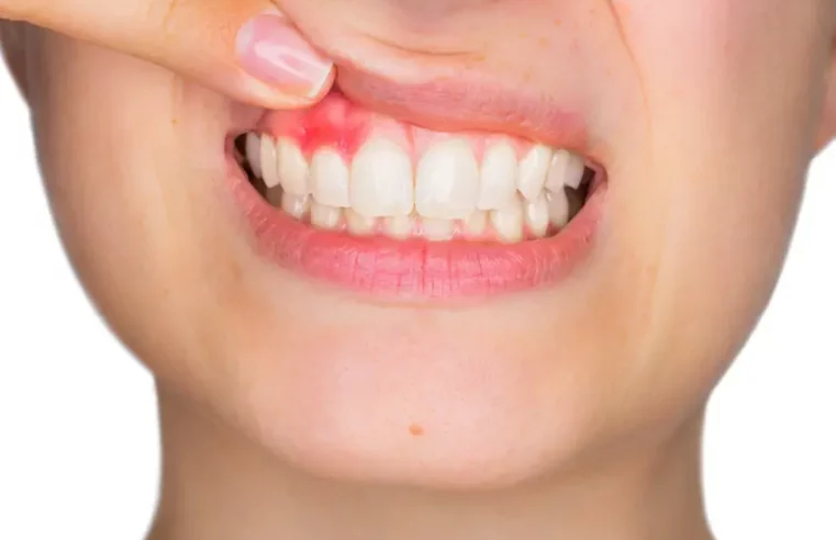 Remedios Caseros Para La PERIODONTITIS O PIORREA