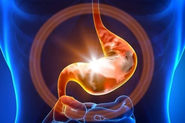 Síntomas principales de Pólipos en el estómago: Cuáles son y causas