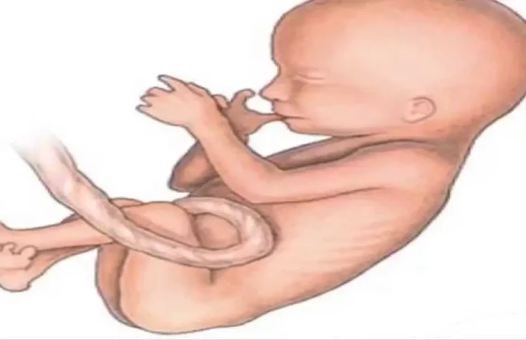 Qué es el gemelo parásito  y por qué sucede