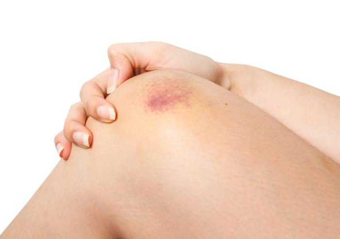 Equimosis: que es, sus principales causas y que hacer