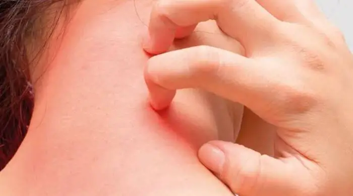 Manchas rojas en la piel: sus causas, síntomas y su tratamiento